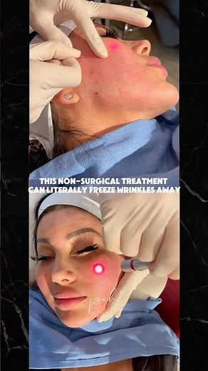 I Got Endolift + Bio Laser for My Face - The Results Are Insane!