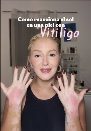 Piel con vitiligo y el sol: Mi reacción
