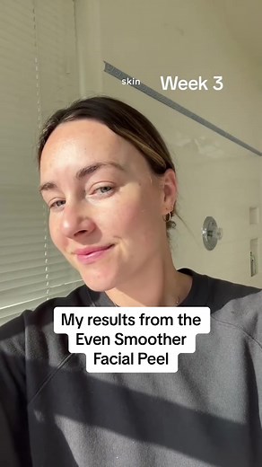 Boost your glow with the Even Smoother® Instant Reveal Facial Peel ✨ @Haley shares her 3-week facial peel results “It’s basically like having a facialist at your house” 🧖‍♀️ Shop the latest drop now at @sephora #PeterThomasRoth #EvenSmoother #InstantRevealFacialPeel #skincare #newatsephora #newskincare #skintransformation #chemicalpeel #facialpeel #glycolicacid