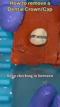 How to Remove Dental Crown Safely | Step by Step Guide #dental #dentalcrowns #zirconiacrown