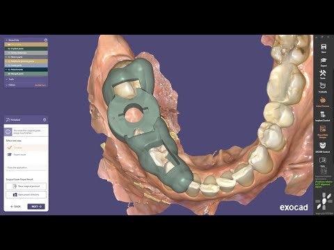 How to Design an Implant Drill Guide in ExoPLAN Guide Creator - IDDA MiniBytes Tutorials
