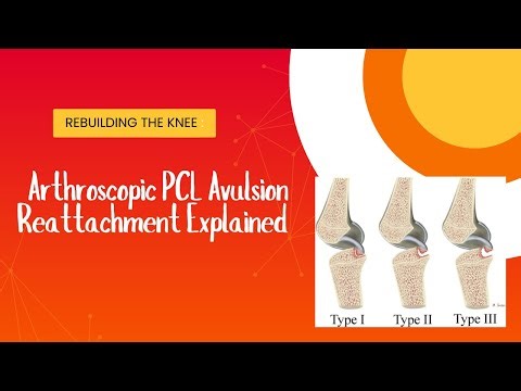 Rebuilding the Knee: Arthroscopic PCL Avulsion Reattachment Explained
