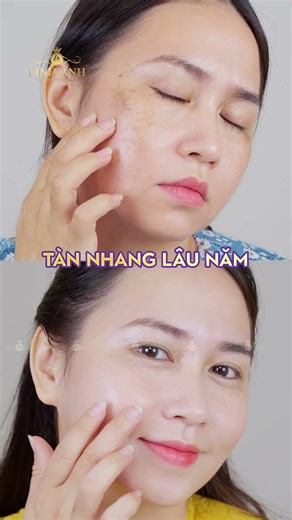 Đốm Tàn Nhang Li Ti Biến Thành Làn Da Trắng Sáng, Mịn Màng - Chỉ Cần 450k Có Ngay Laser Sắc Tố