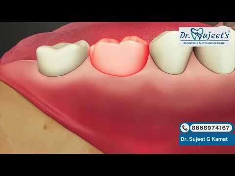 Alternatives to Root Canal Treatment | Save Your Tooth Without RCT? | Dr. Sujeet Dental Care #video