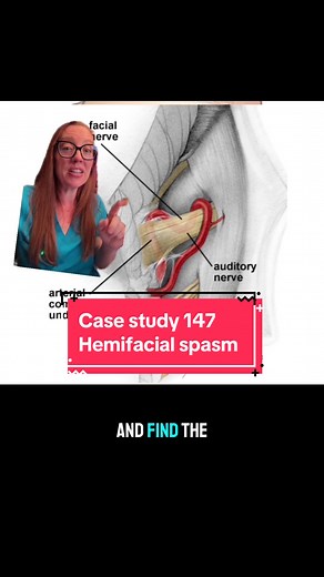 Replying to @Erica G755 Case Study 147 - Hemifacial Spasm Hemifacial spasm is a neuromuscular disorder that involves frequent contractions or spasms of the muscles on one side of the face. The spasms are involuntary, meaning they happen on their own without trying. The first symptom is usually twitching of the eyelid muscle that comes and goes. Eventually the spasms involve all of the muscles on one side of the face almost nonstop. Most often hemifacial spasm is caused by a blood vessel pressing