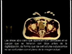 The Visible Human Project