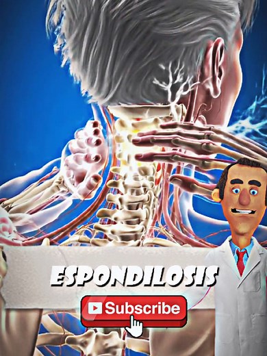 Entendiendo la Espondilosis Cervical