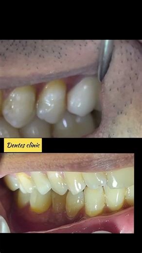 Dental Crown with Digital Dentistry in Dentes Clinic #dentist #dentalcare #smilemakeover