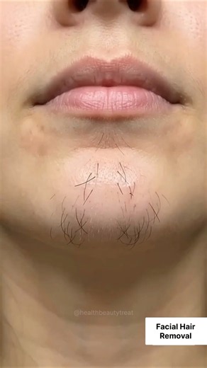 Painless😨 Facial Hair Removal Easy Remedy | Remove Unwanted Facial Hair At Home #facialhair #shorts