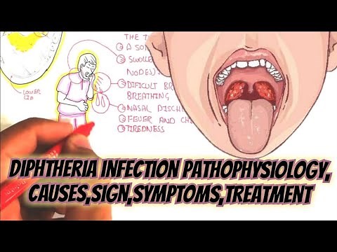 Diphtheria Infection Pathophysiology, Causes,Sign,Symptoms,Treatment