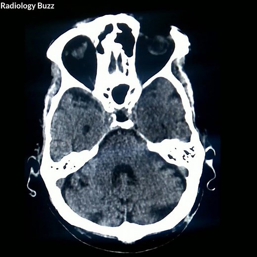 A Case of diffuse age relatives cerebral atrophy with chronic ischemic changes. #Radiology_buzz
