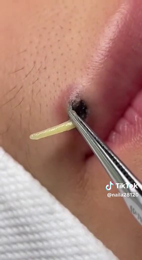 Effective Blackhead Removal Techniques for Lips