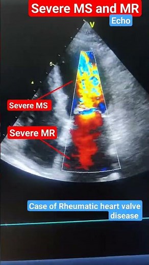 Echo of severe MS and MR l RHD l Tight mitral valve #echo #shorts