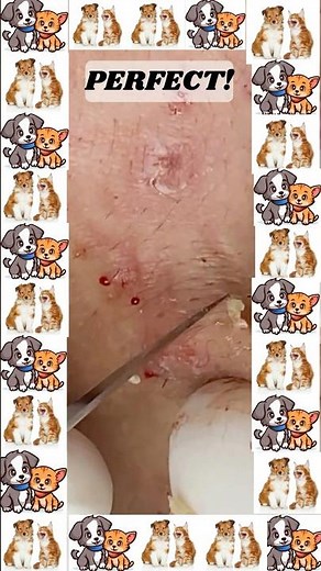 Pickel Explosion Popping Pimples