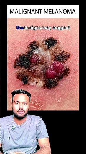 This Mole Looks Normal… Or Is It Skin Cancer? ⚠️