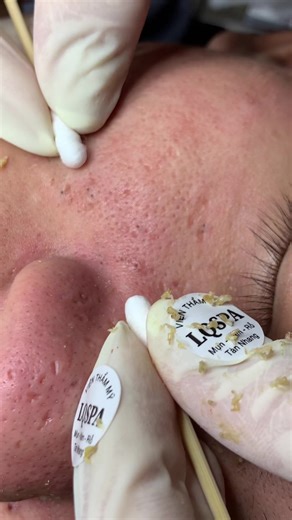 Gom#chamsocdamun#chamsocdaseo#chamsocdanam#tanbinh#Lqspa&academy