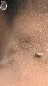 Sandra Lee, MD, FAAD, FAACS | Ready for another Dr. Pimple Popper story time?! Another installment of Skittle Steatocystomas up now on YouTube! Catch a new chapter every... | Instagram