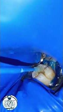 Repairing a decayed tooth...#Dentistry