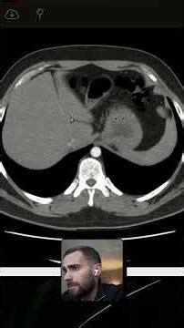 EDN Chest CT Anatomy 🩻