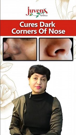 Cure Dark Corners of Nose #nose #whiteheads #blackheads #melanin #corners #pigmentation #shorts