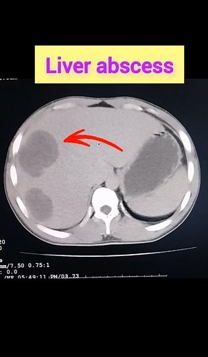 Liver abscess