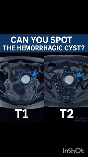 Hemorrhagic Cyst on MRI — The Key Signs You MUST Know”