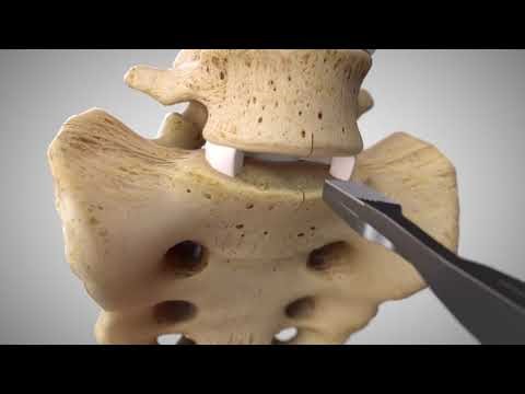 Prodisc Lumbar Artificial Disc Replacement (ADR) Surgical Animation