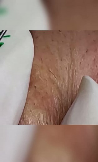 #spa #acneskin #acnefighter