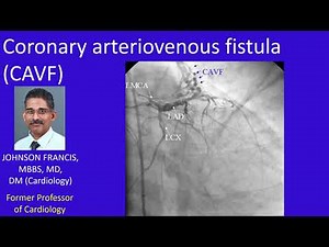 Coronary arteriovenous fistula (CAVF)