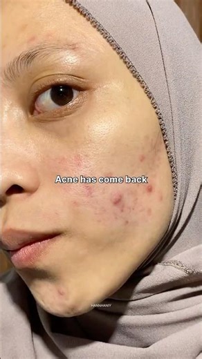 My acne came back… so I used this 💦