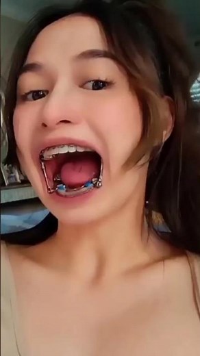 Herbst Appliances Explained #shorts