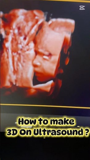 How to make 3D On Ultrasound?
