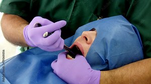 Dentist Pulling Molar Close Up Stock Video