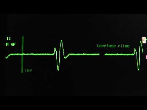 ventricular escape rhythm on an ECG heart monitor