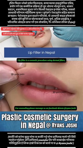 Lip filler is a cosmetic procedure using dermal fillers, usually hyaluronic acid, injected into the lips to add volume, enhance shape, correct asymmetry, and smooth lines, with temporary results lasting months and common brands including Juvéderm and Restylane . Performed by professionals, it's a popular, non-surgical way to achieve fuller, more hydrated, and defined lips, with minor swelling or bruising as temporary side effects . What it is Dermal fillers: Substances injected to plump and cont