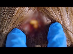 New fear unlocked: Maggots growing on the scalp?!💀【Collection】