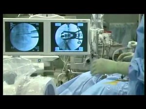 Minimally invasive lumbar spine surgery: XLIF®