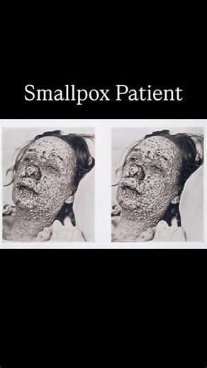History Everyday on Instagram: "This photograph from 1908 shows a patient in the advanced stage of smallpox, when the skin becomes covered with hundreds of raised pustules. The illness often began with high fever, severe headache, back pain, and vomiting. A rash followed a few days later, starting on the face and spreading across the body. These lesions would fill with fluid, harden into pustules, and eventually scab over, often leaving deep scars. In severe cases, the pustules were so dense tha