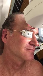 Fractional CO2 Laser with PRP