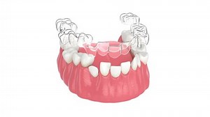 Clear Aligner Splint Make Bite Correction Stock Footage Video (100% Royalty-free) 1063017313 | Shutterstock