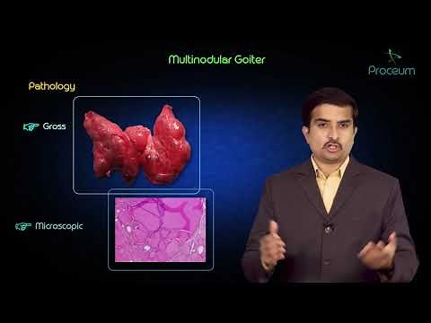 Multinodular goitre - Usmle step 1 pathology lecture and case presentation