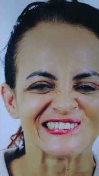 Genioplasty | Chin Reshaping Surgery