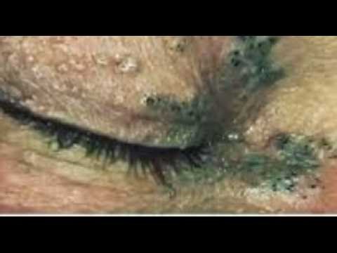 😱 CRAZY EXTRACTION 😱 | Sac Dep Spa #0018