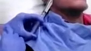 Pimples Cyst Zits Popping New 2017