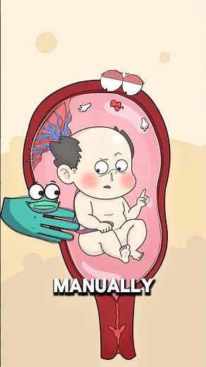 How Doctors Turn a Baby for a Safer Delivery 🤰👶..!!#e2dhealth #animation #fypシ #2dshow #health