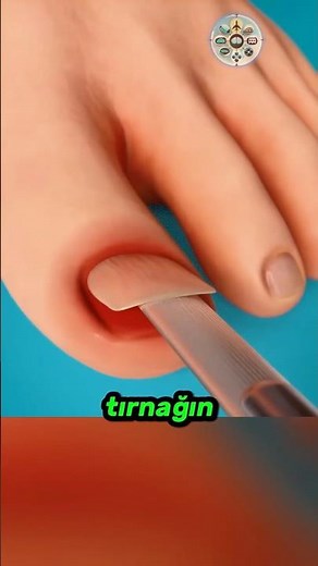 Tırnak Batması Nasıl Tedavi Edilir? 👣🩺🩹