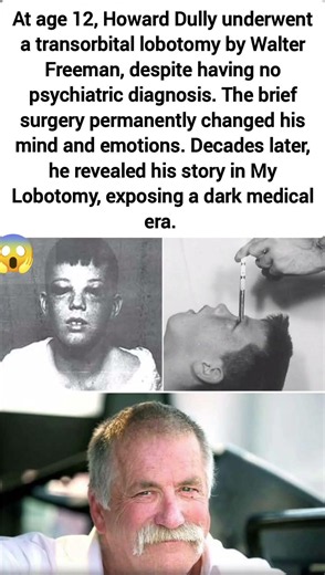 The Boy Who Had a Lobotomy: Howard Dully’s Tragic Story #viral #humanity #history #psychology #
