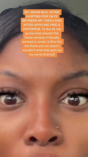 Effective Home Remedies for Boils and Cysts: A Quick Relief Guide