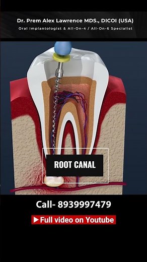 Front Tooth Replacement From Fillings to Implants | #shorts