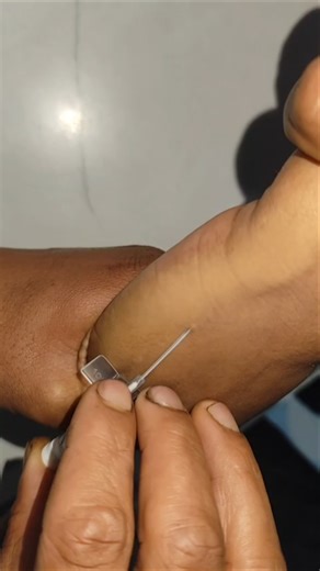 IV Cannulation technique video part432#mbbs #motivation #viral #shorts